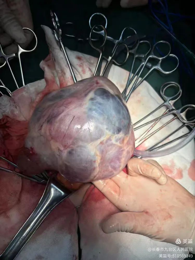 九台区人民医院妇科成功完成一例左侧卵巢巨大粘液性囊腺瘤切除手术